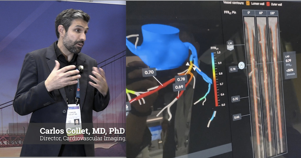 CCTA will play an essential role in the cath labs of the future